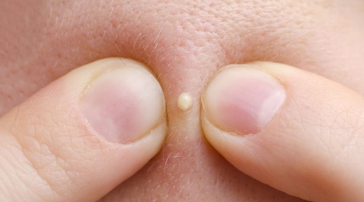 ترکاندن جوش از اشتباهات رایج روتین پوستی