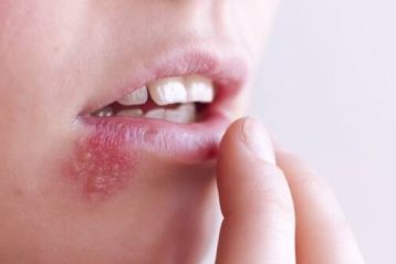 ویروس تبخال می‌تواند باعث افزایش ریسک ابتلا به زوال عقل شود