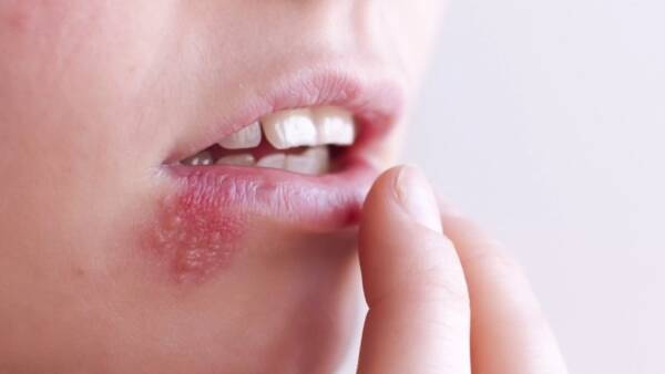 ویروس تبخال می‌تواند باعث افزایش ریسک ابتلا به زوال عقل شود