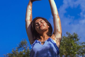 فردی که دست‌هایش دچار پیسی شده است