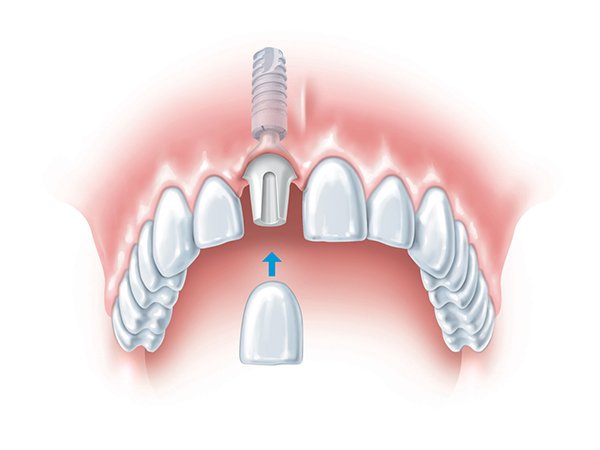 هزینه کاشت دندان جلو چطور تعیین می شود_سمسون 14 مزایای کاشت دندان جلو