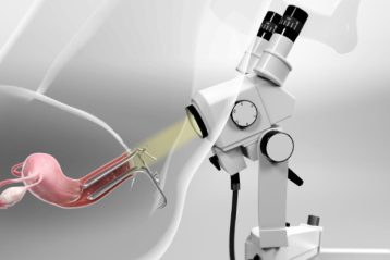 کولپوسکوپی - در طول کولپوسکوپی