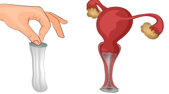 کاندوم زنانه؛ انواع، مزایا، معایب و روش استفاده_سمسون 7 نحوه استفاده از کاندوم زنانه