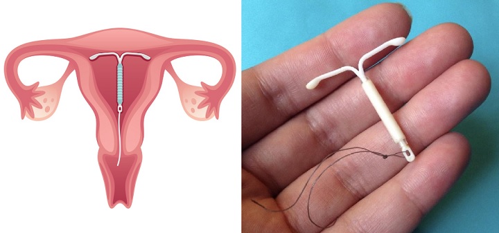 آی یو دی از روشهای پیشگیری از بارداری که می تواند موجب متروراژی شود