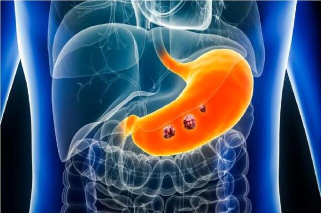پیشرفت چشمگیر در تشخیص زودهنگام سرطان معده با استفاده از هوش مصنوعی