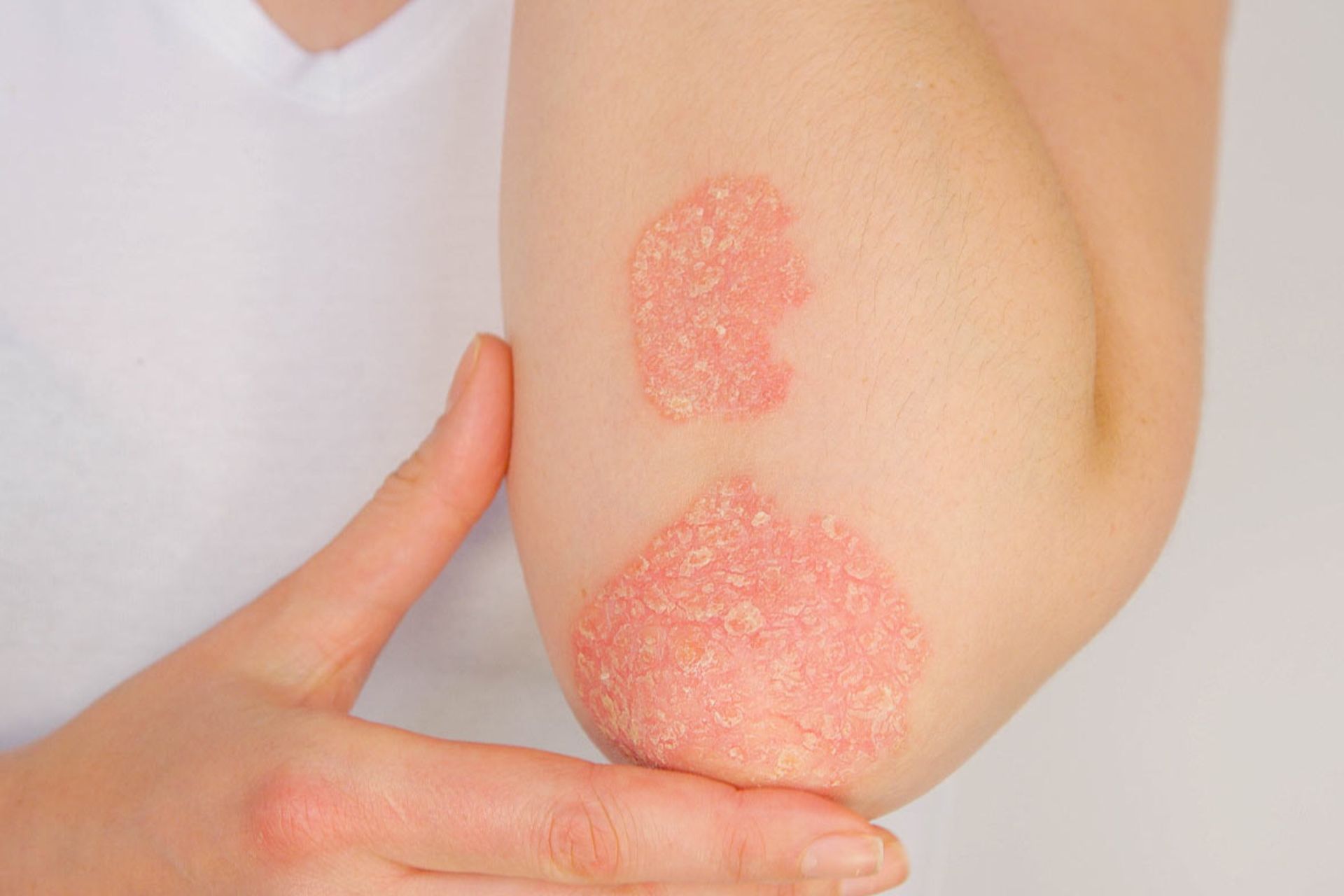 بهترین درمان برای خارش پوست_سمسون 8 Psoriasis(پسوریازیس)