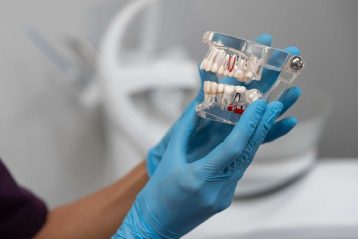 ایمپلنت دیجیتال