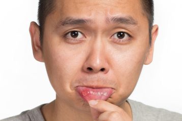 آفت دهان معمولا زخمی گرد یا بیضی شکل سفید یا زرد رنگ است که دور تا دور آن قرمز شده باشد ـ درمان آفت دهان