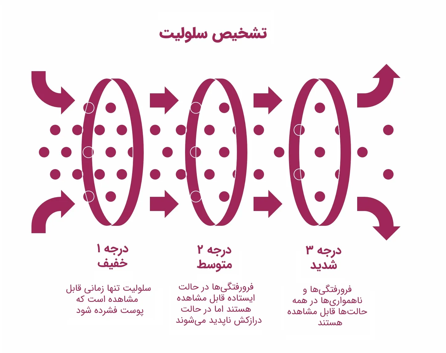 تفاوت لیپیدما و سلولیت: راهنمای تشخیص و درمان_سمسون 11 اینفوگرافیک درجهبندی شدت سلولیت